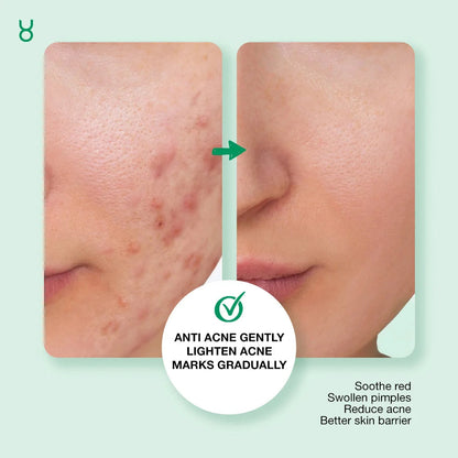 Tea Tree Anti Acne Gently Lighten Acne Mask